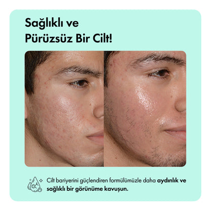 Anti-Acne Serumu