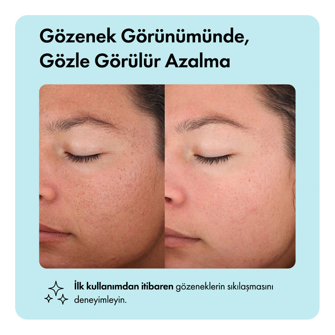 Zero Pore™ Temizleme Barı ys-zeropore-cod-tk