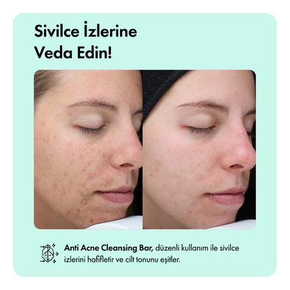 Anti-Acne Temizleme Barı