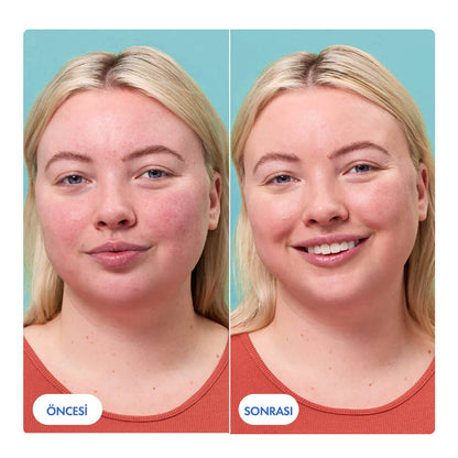 Anti-Redness Kızarıklık Karşıtı Serum