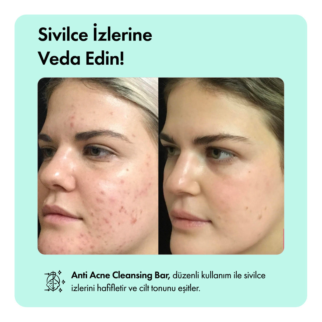Anti-Acne Serumu