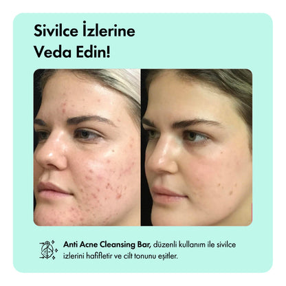 Anti-Acne Serumu
