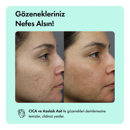 Anti-Acne Serumu