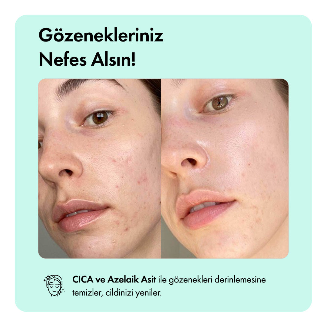 Anti-Acne Temizleme Barı