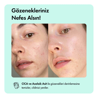 Anti-Acne Temizleme Barı